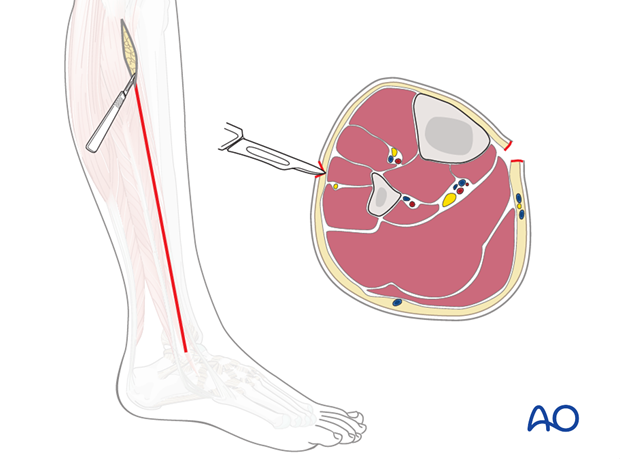 compartment syndrome