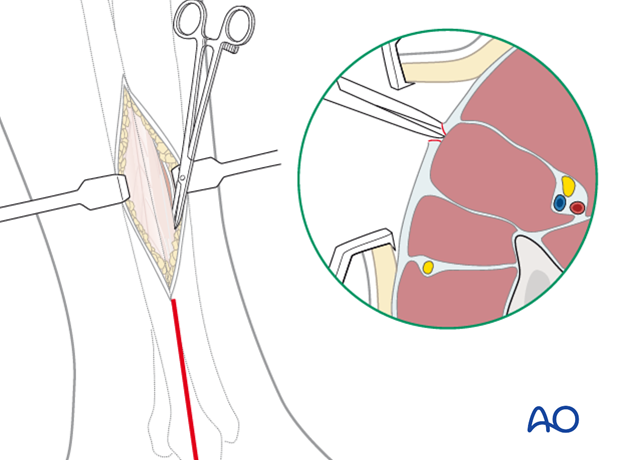 compartment syndrome