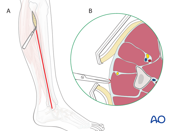 compartment syndrome