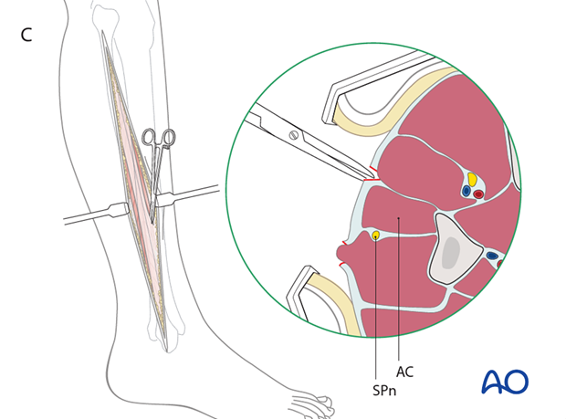 compartment syndrome