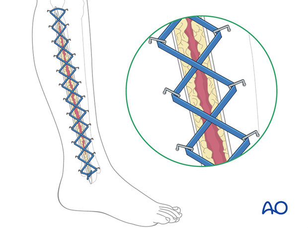 compartment syndrome