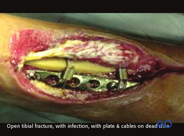 classifications of wound infection