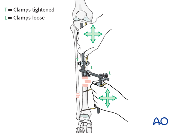 modular external fixator