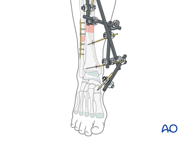 modular external fixator