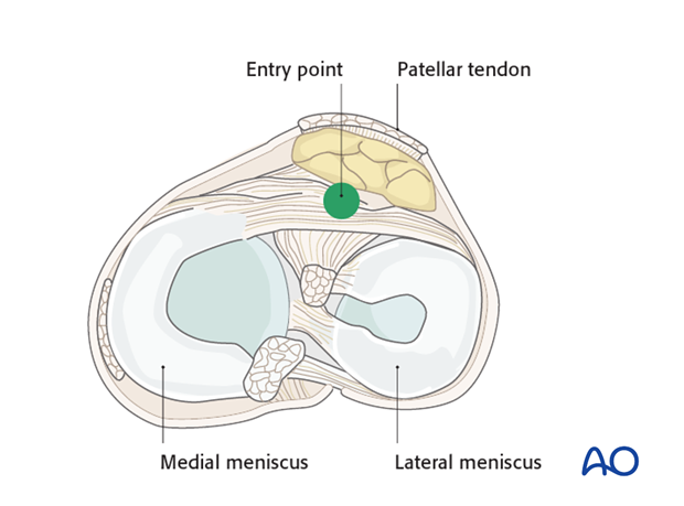 nailing limited open approach to the distal tibia