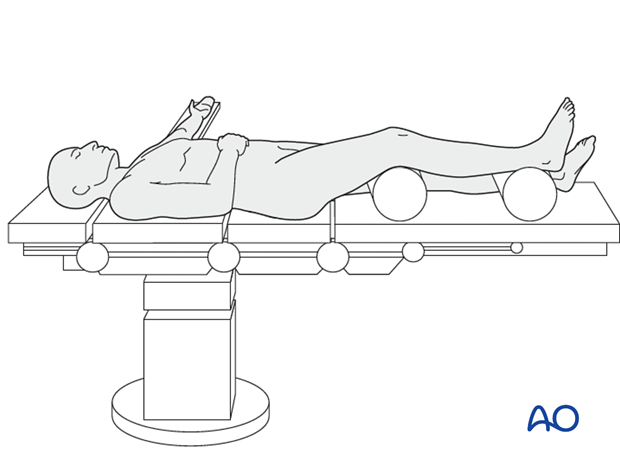 Supine position for ring fixator