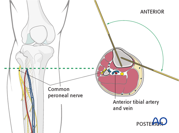 safe zones of the tibia for pin insertion