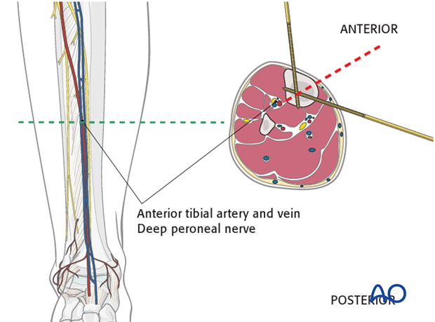 safe zones of the tibia for pin insertion