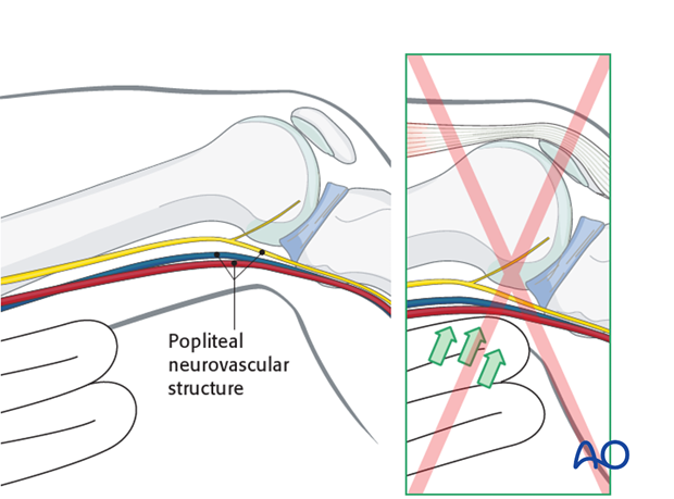 supine position for nailing