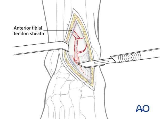 anteromedial approach to the distal tibia