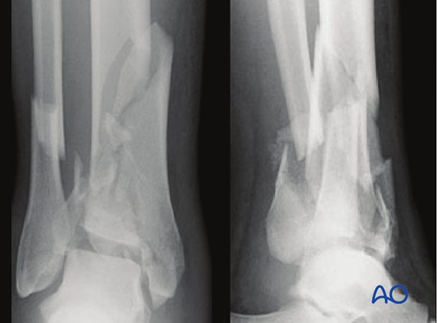 anterolateral approach to the distal tibia