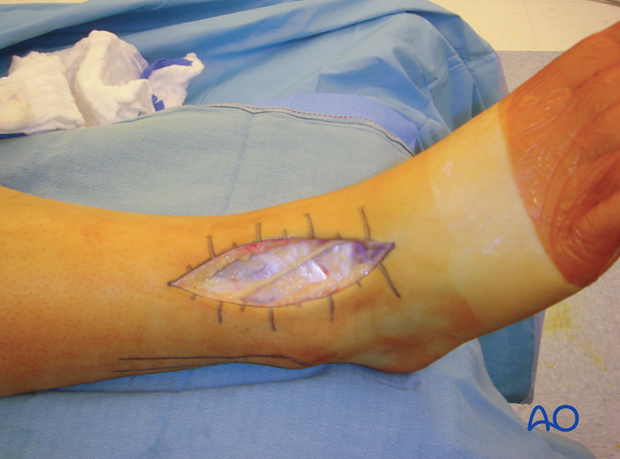 anterolateral approach to the distal tibia