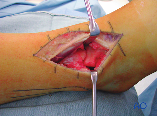 anterolateral approach to the distal tibia