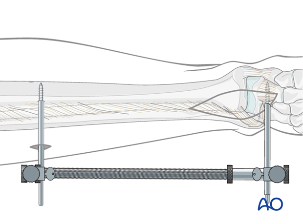 anterolateral approach to the distal tibia