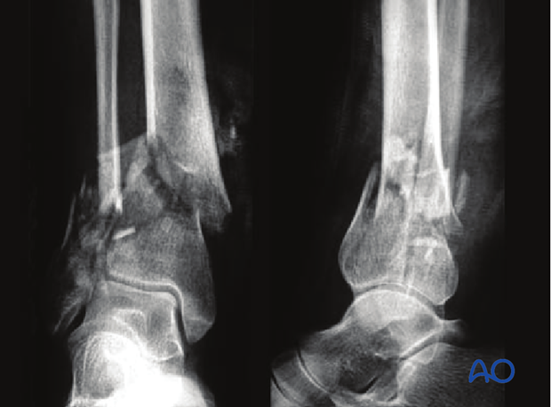 minimally invasive approach to the distal tibia