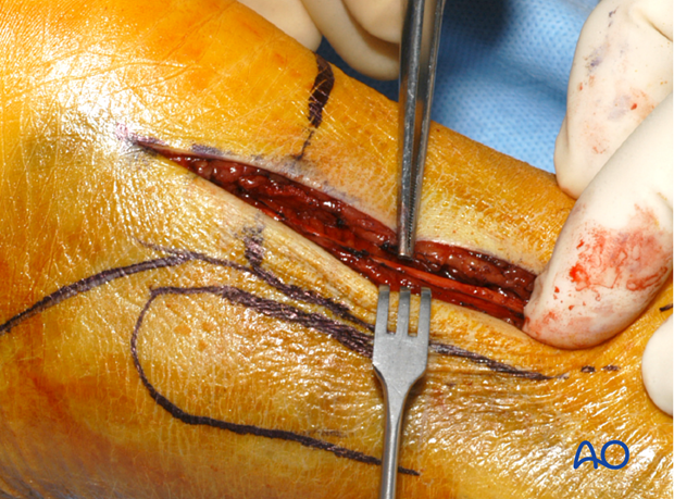 posterolateral limited open approach to the distal tibia