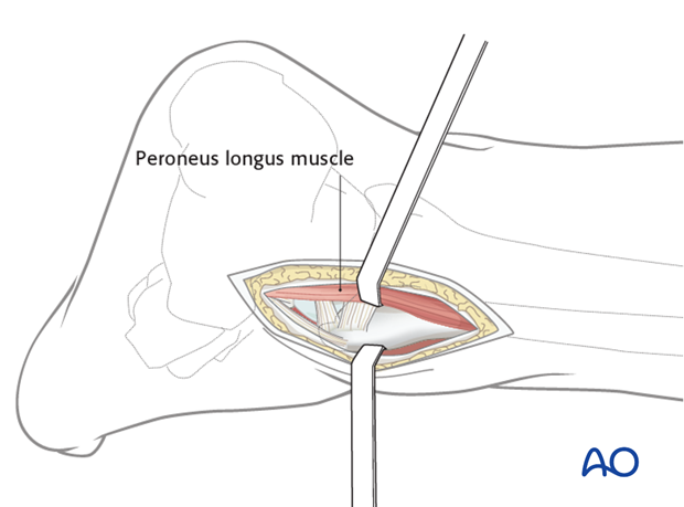 posterolateral limited open approach to the distal tibia