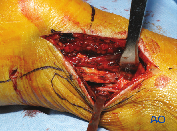 posterolateral limited open approach to the distal tibia