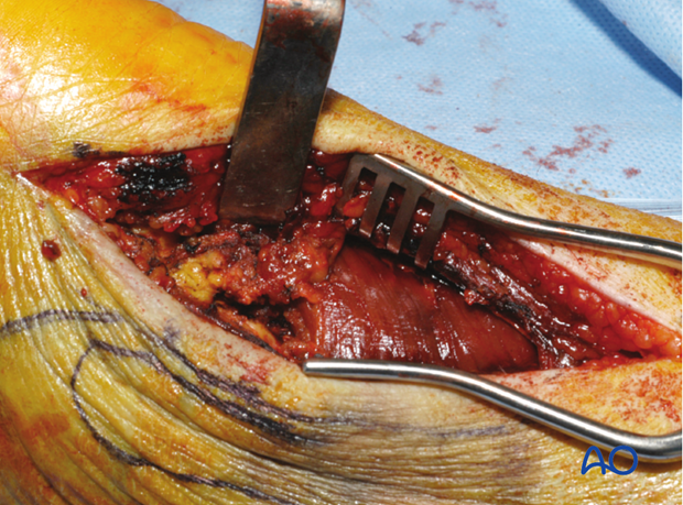 posterolateral limited open approach to the distal tibia