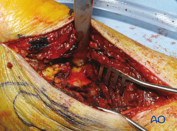 posterolateral limited open approach to the distal tibia