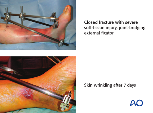 Example of closed fracture with severe soft-tissue injury, joint-bridging external fixator