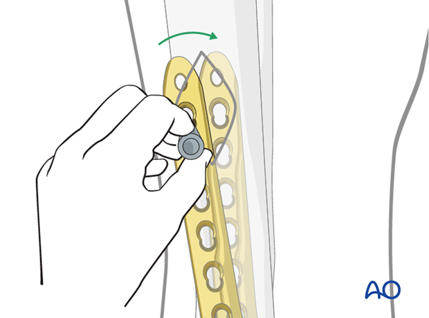 Plate repositioning to treat distal tibia fracture