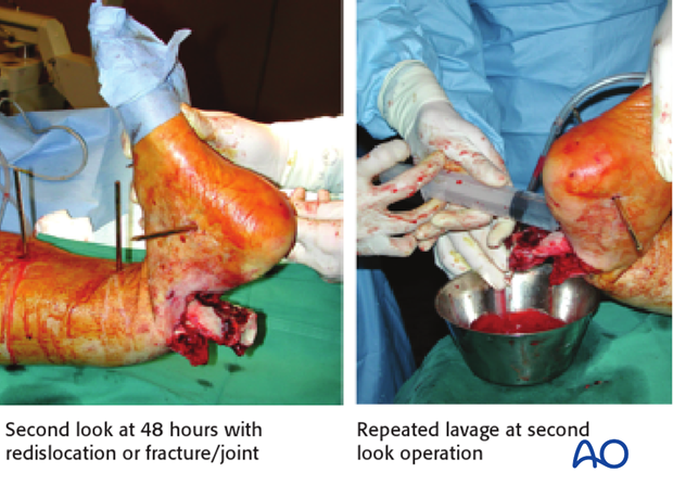 Example of open fracture redislocation at 48 hours