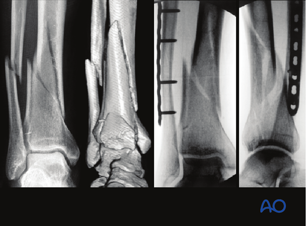 Radiograph of fibula and distal tibia fracture treated with plate fixation