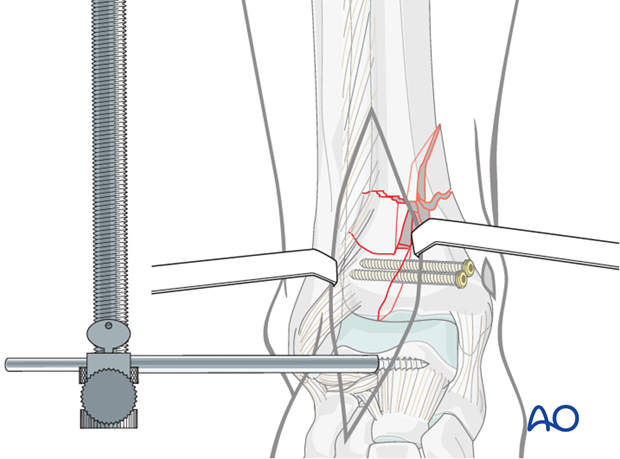 Reduction and stabilization of the articular segment in a complete articular distal tibia fracture