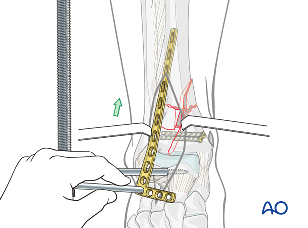 Plate insertion to treat distal tibia fracture