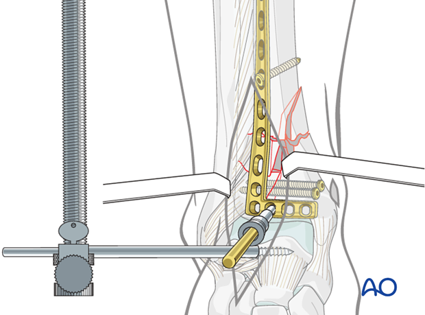 Temporary plate fixation to treat a distal tibia fracture