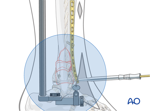 Distal screw positioning for plate fixation to treat distal tibia fractures