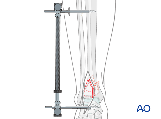 Distractor application in a distal tibia fracture