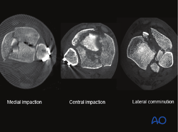 anteromedial or anterolateral approach