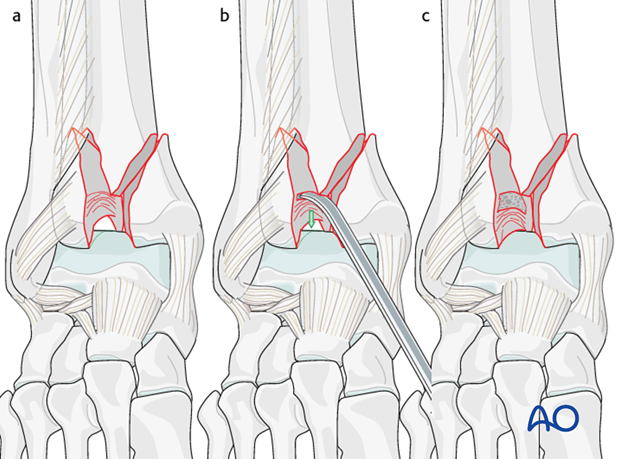 anteromedial or anterolateral approach