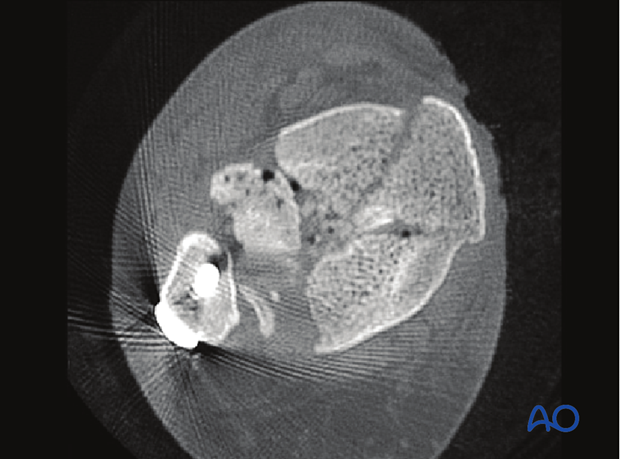 anteromedial or anterolateral approach