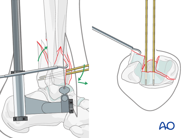 Preliminary fixation of the posterolateral fragment in a complete articular fracture of the distal tibia