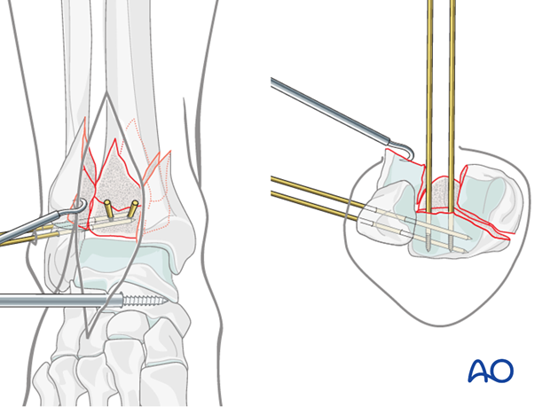 Preliminary fixation with K-wires of the posterolateral fragment in a complete articular fracture of the distal tibia