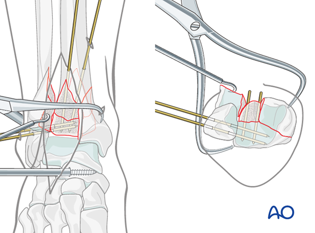 Alternative preliminary fixation of the medial fragment in a complete articular fracture of the distal tibia