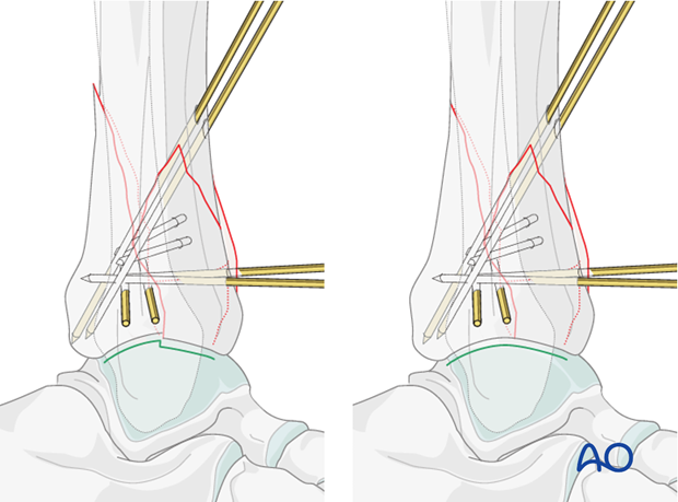 Articular surface reduction in a complete articular fracture of the distal tibia