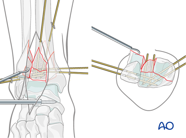 Stabilization of the medial and posterolateral fragments in a complete articular fracture of the distal tibia