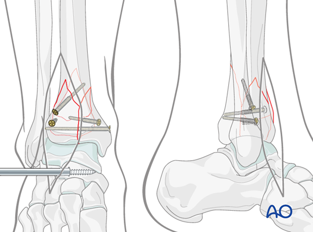 Lag screw fixation in a complete articular fracture of the distal tibia