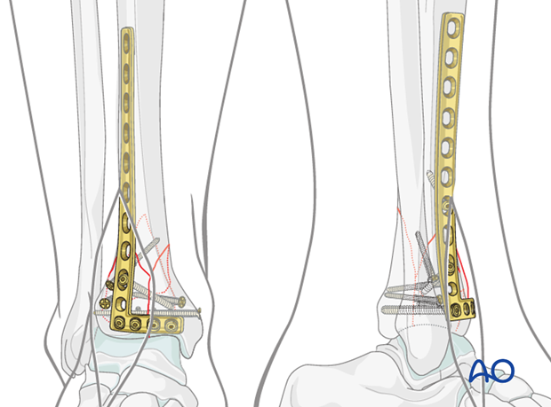 Distal screw placement in lateral plate fixation in a complete articular fracture of the distal tibia