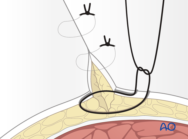 Wound closure