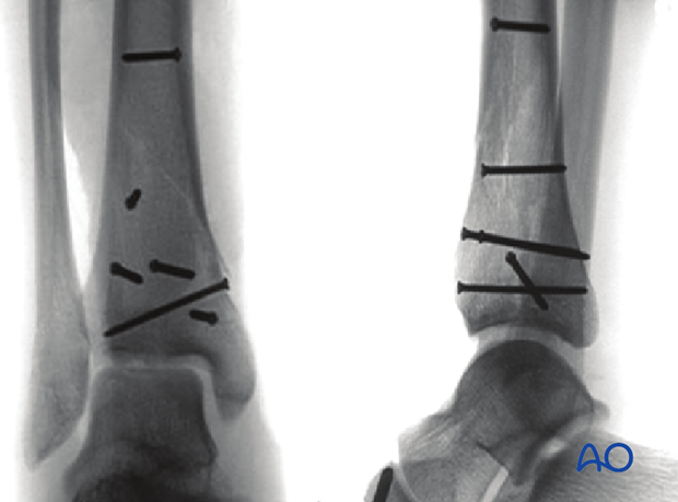 Radiographic example of lag screw positioning for fixation of a 3-part multifragmentary complete articular distal tibia fracture