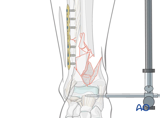 Plating of the fibula in a distal tibia and fibula fracture