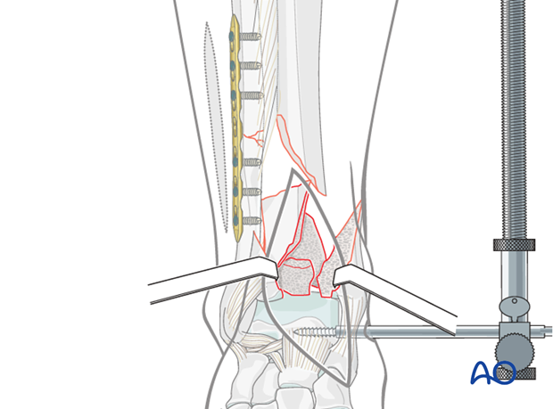 Cleaning of the fractured area in a distal tibia and fibula fracture