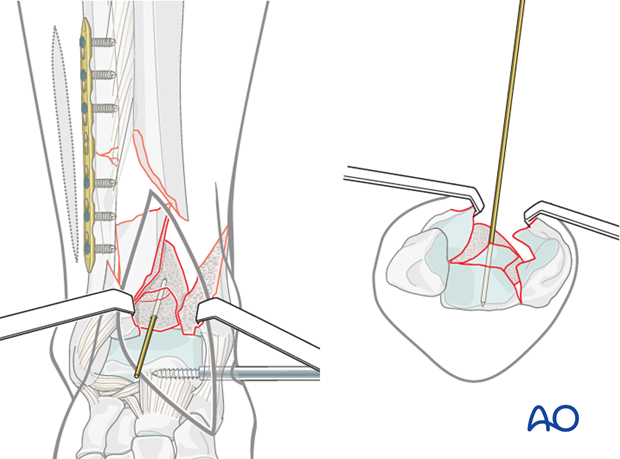 Reduction of the central fragment in a complete articular multifragmentary distal tibia fracture