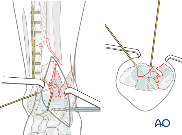 Reduction of the anterolateral fragment in a complete articular multifragmentary distal tibia fracture