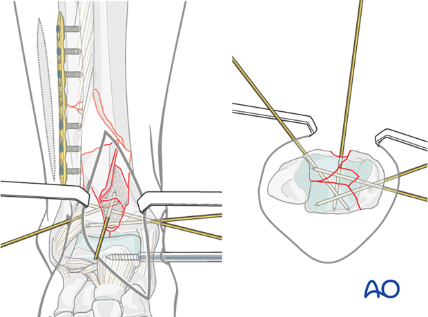 Reduction of the medial fragment in a complete articular multifragmentary distal tibia fracture